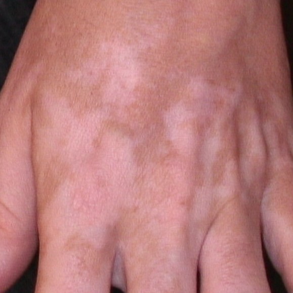 Vitiligo Treatment