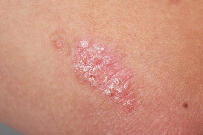 Psoriasis UVB Treatments