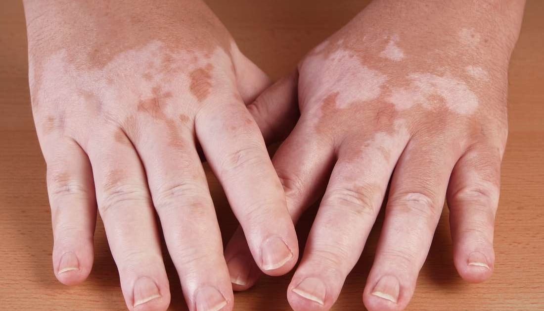 Vitiligo Treatment